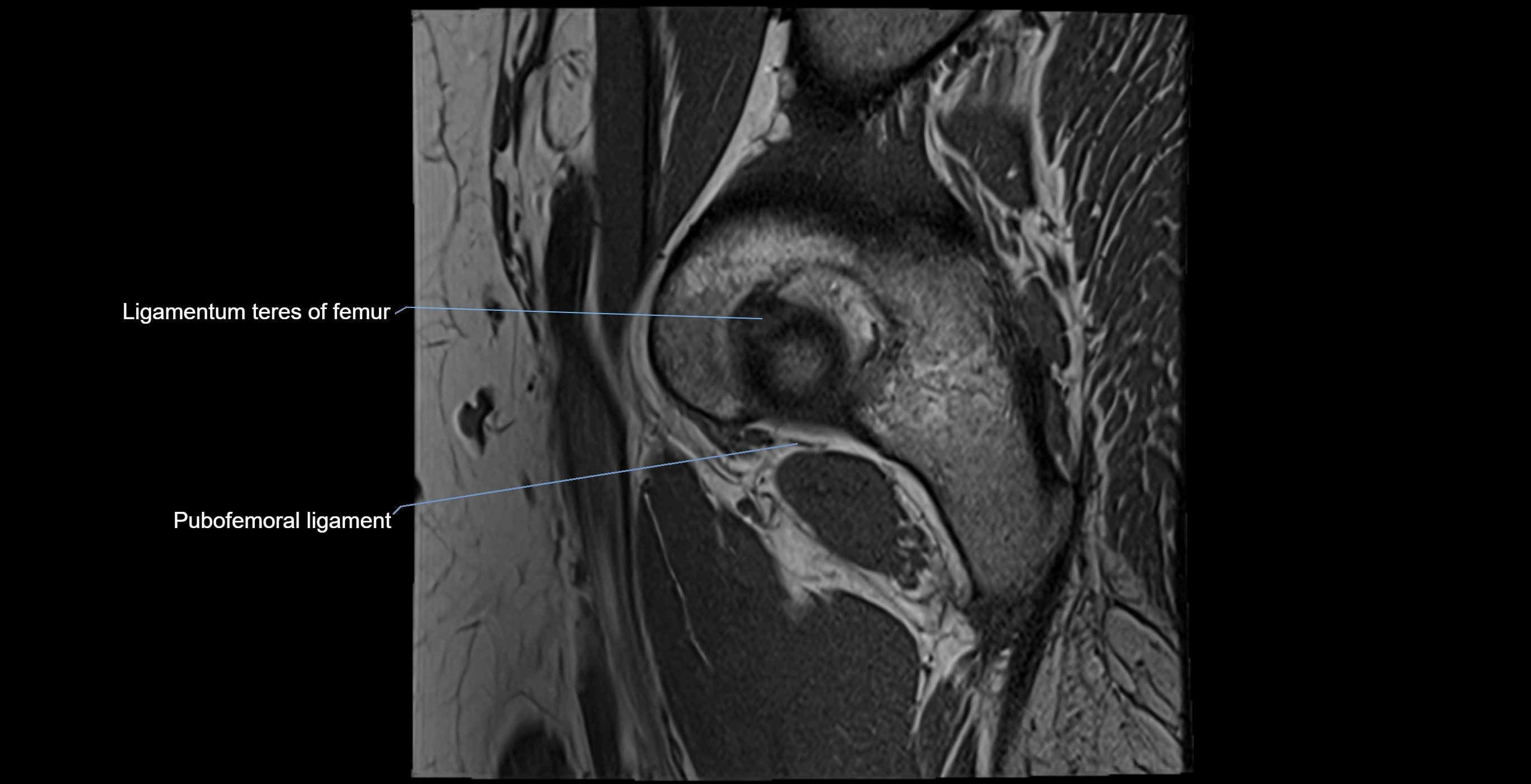 MRI Hip ligaments sagittal cross sectional anatomy 3T  radiology  image-img-00001-00003.webp